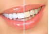 Фото Белые зубы на 5 тонов за 14 дней (США)
