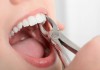 Удаление зубов в Бирюлево
