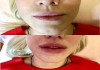 Фото Увеличение губ