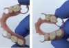 Протезы зубные эластичные из гибкого полимера