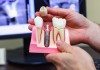 Фото Имплантация зубов в Рязани